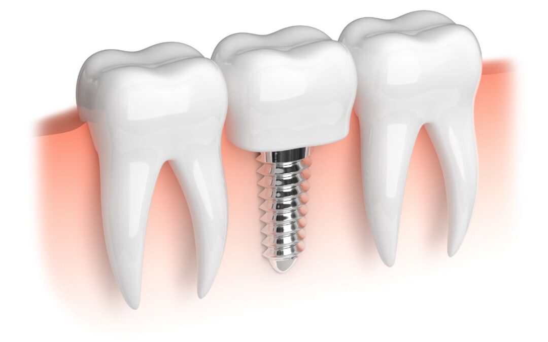 Implant Dentistry