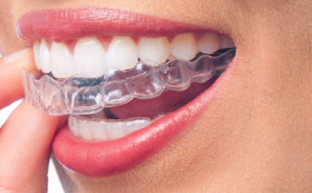 Invisible Braces
