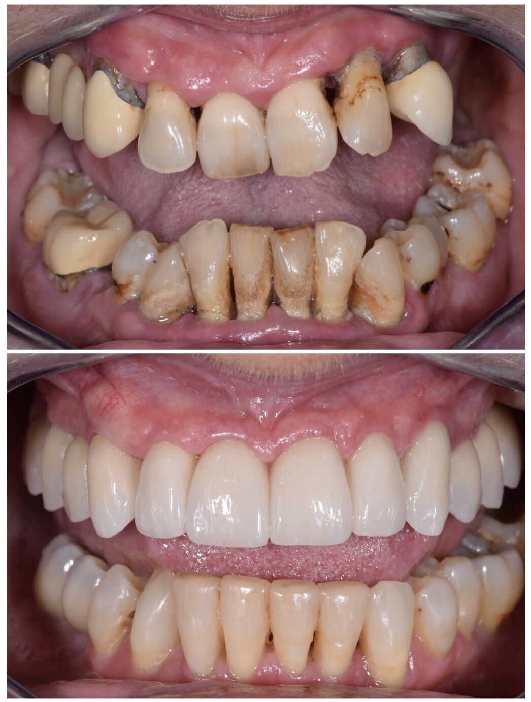 Fillings
