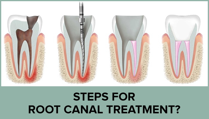 Root Canal Treatment Steps
