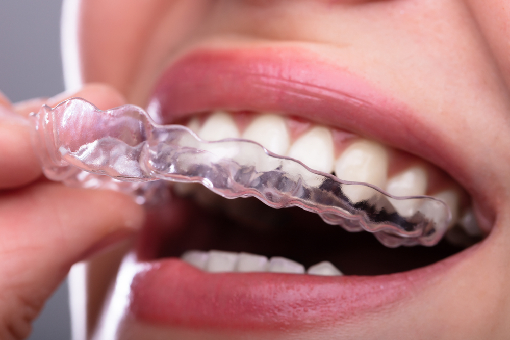 Invisible Braces